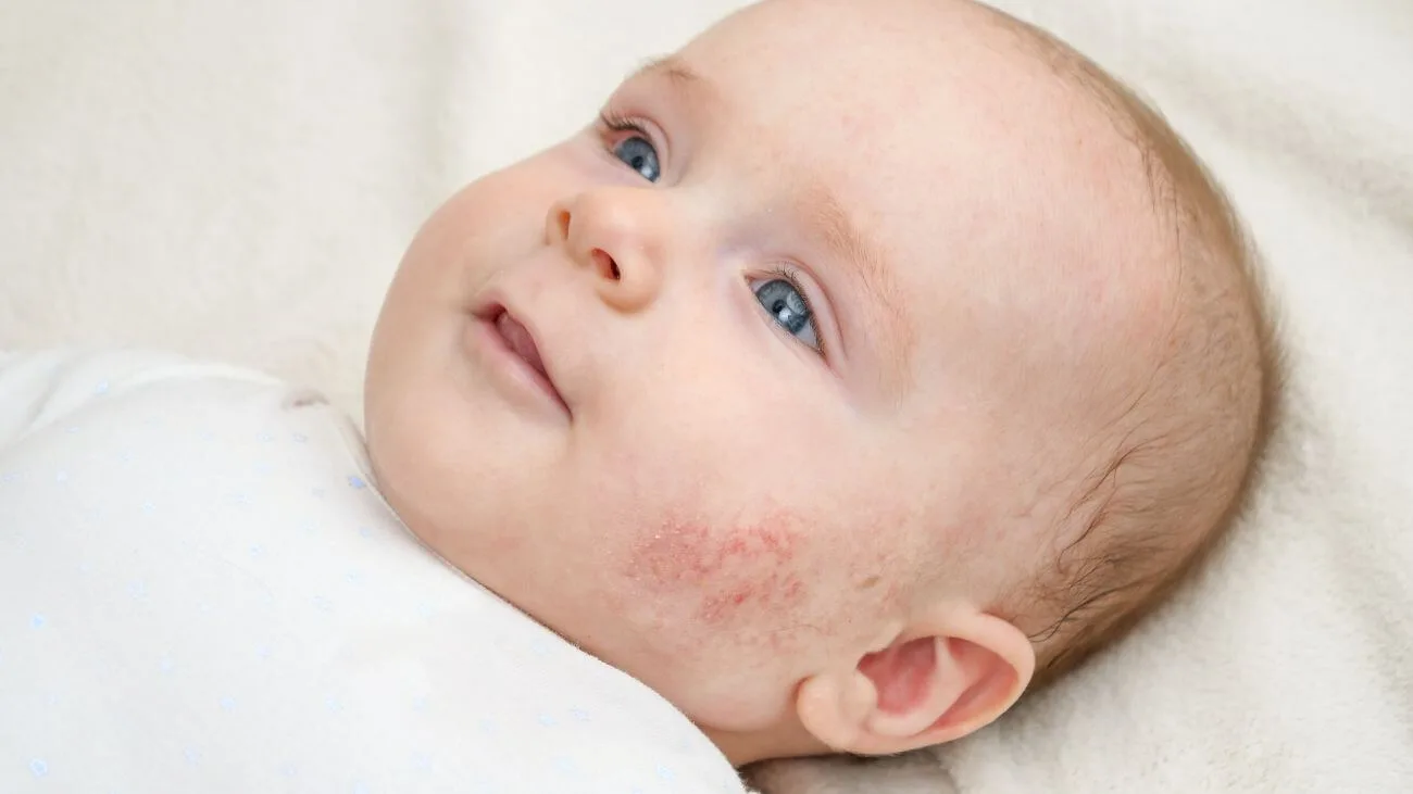 Problemy ze skórą głowy u dzieci i niemowląt