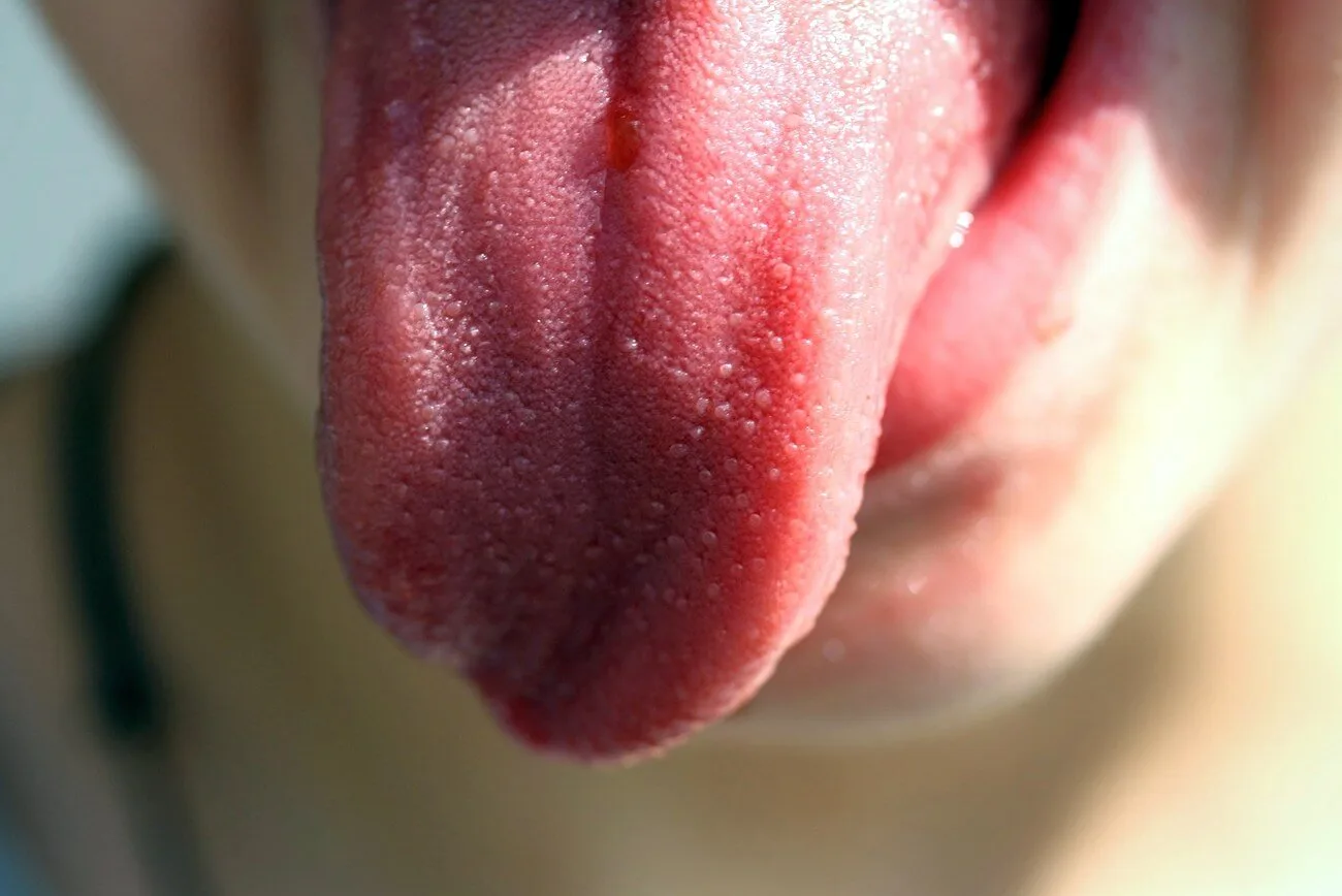Ból języka objawy przyczyny i leczenie
